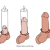 How Often Should You Use a Penis Pump